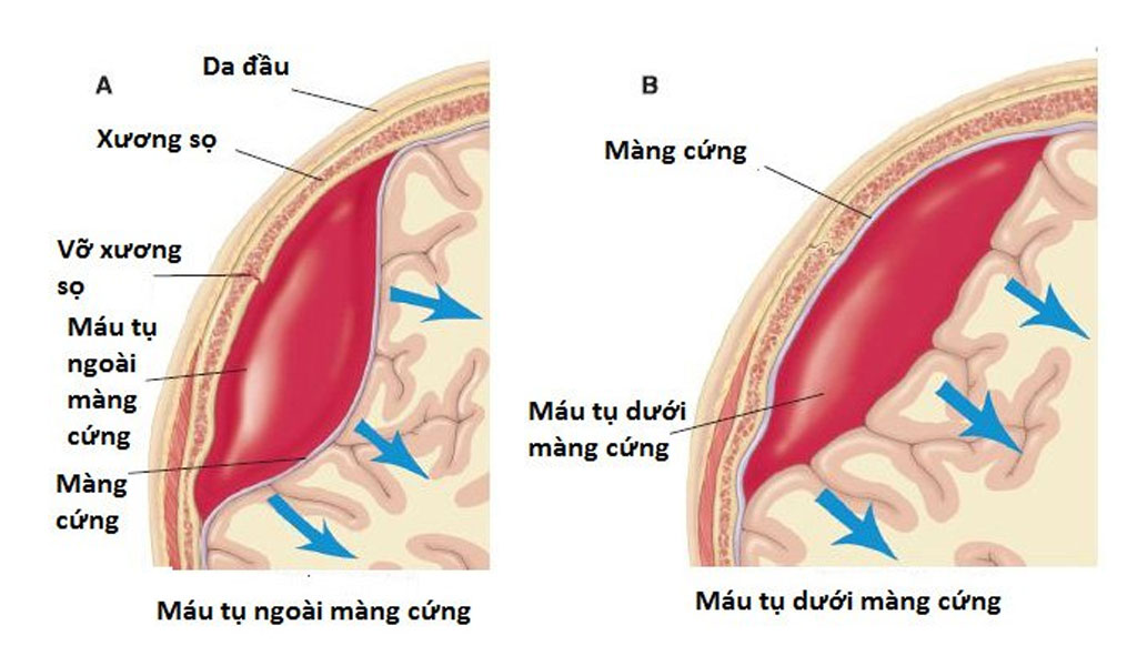 Tình trạng máu tụ dưới màng cứng của đầu có thể được điều trị như thế nào?