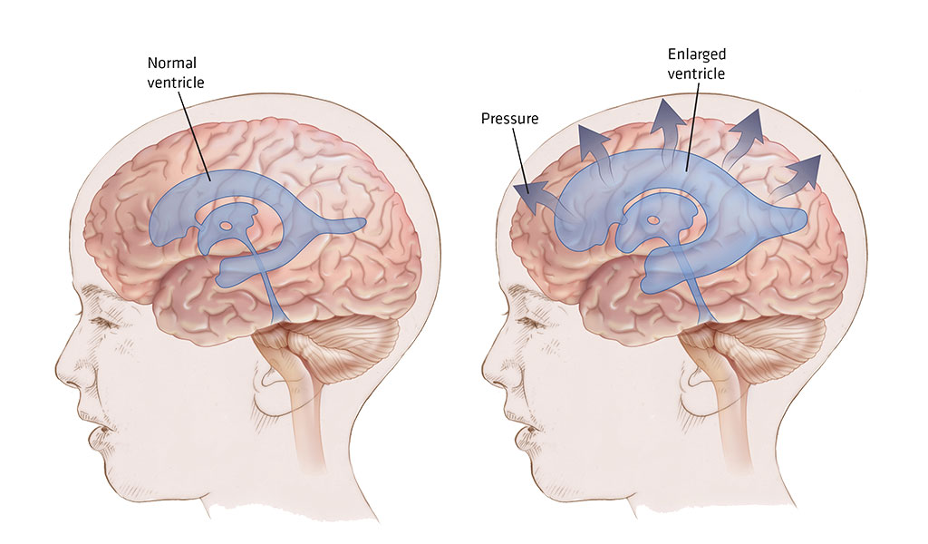 Bệnh giãn não thất áp lực bình thường (normal pressure hydrocephalus -NPH) là gì?