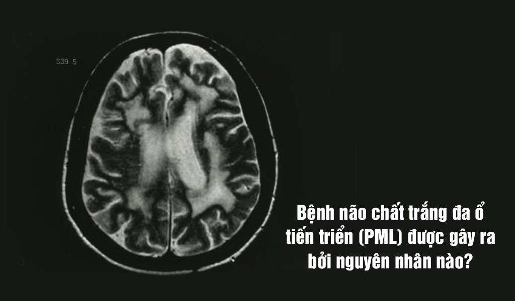 Bệnh não chất trắng đa ổ tiến triển (PML) được gây ra bởi nguyên nhân nào?