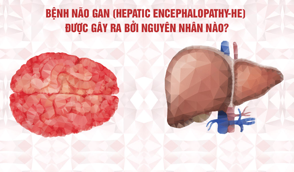 Bệnh não gan (Hepatic encephalopathy-HE) được gây ra bởi nguyên nhân nào?