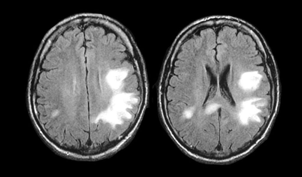 Bệnh não chất trắng đa ổ tiến triển (PML - progressive multifocal leukoencephalopathy) liên quan đến bệnh đa xơ cứng (MS) và bệnh Crohn như thế nào?