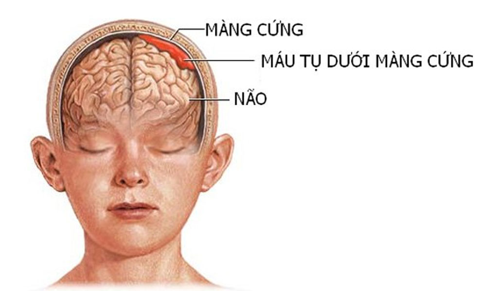 Làm thế nào để chẩn đoán sớm bệnh não chấn thương mạn tính (CTE)?