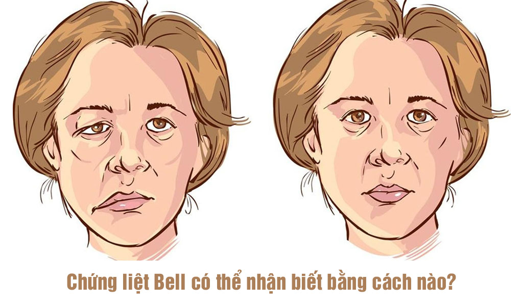 Chứng liệt Bell có thể nhận biết bằng cách nào?