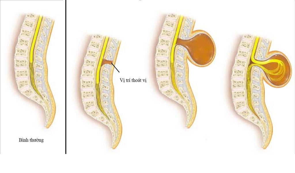 Dị dạng Chiari có thể mắc phải vào những giai đoạn nào?