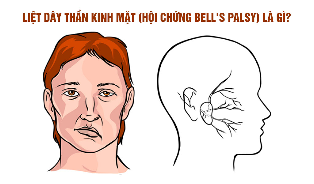 Liệt dây thần kinh mặt (hội chứng Bell