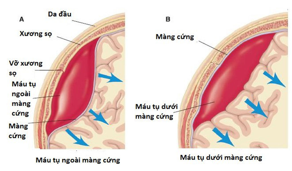 Những thông tin nào về tình trạng máu tụ dưới màng cứng mà bạn nên biết?