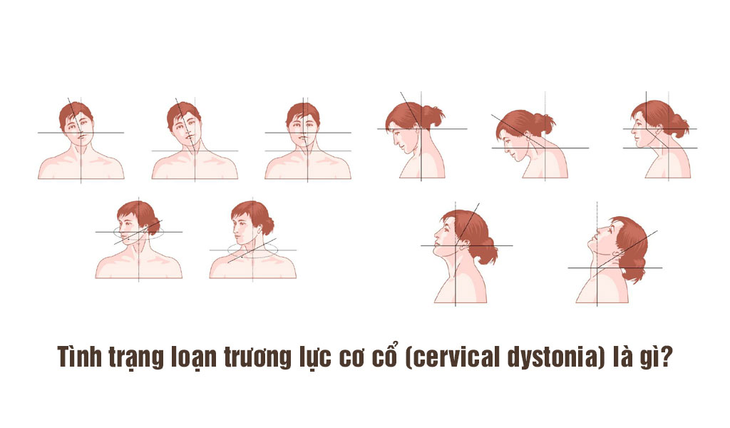 Tình trạng loạn trương lực cơ cổ (cervical dystonia) là gì?