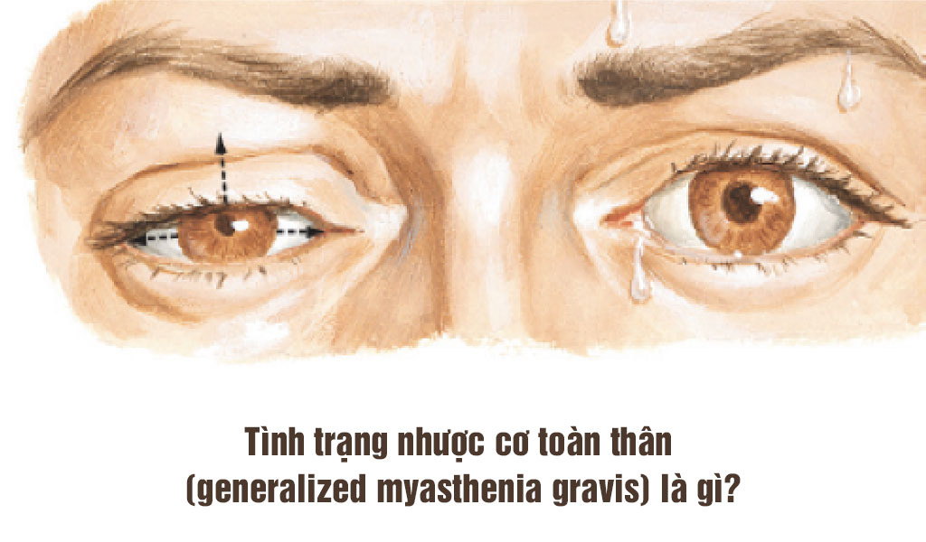 Tình trạng nhược cơ toàn thân (generalized myasthenia gravis) là gì?