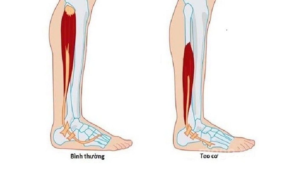 Trong điều trị bệnh xơ cứng teo cơ một bên (ALS) thì những liệu pháp điều trị nào thường được sử dụng?