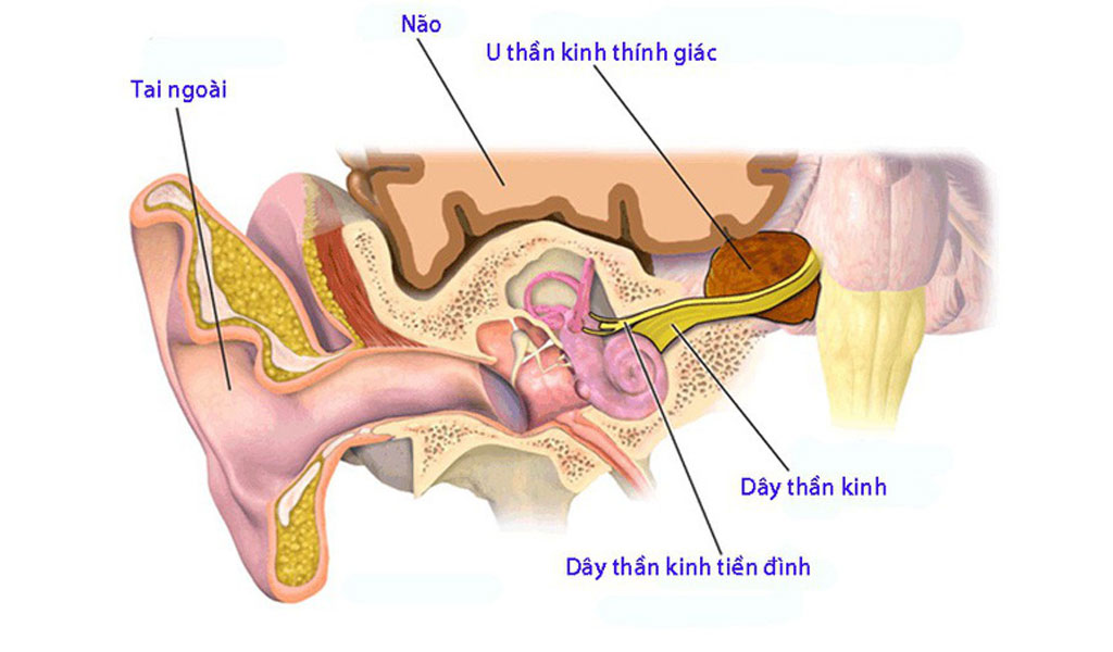 U dây thần kinh thính giác được gây ra bởi những nguyên nhân nào?