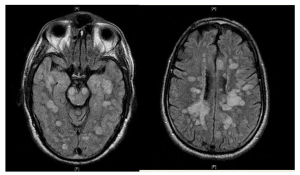 Viêm não tủy cấp lan tỏa (ADEM -  triggers acute disseminated encephalomyelitis) được gây ra do nguyên nhân nào?