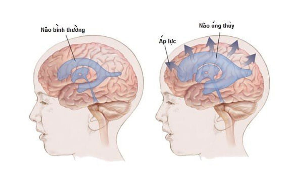 Tại sao bệnh giãn não thất áp lực bình thường (NPH) lại gây khó khăn trong việc chẩn đoán?