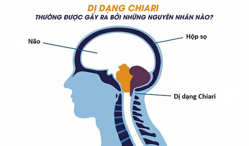 Dị dạng Chiari thường được gây ra bởi những nguyên nhân nào?