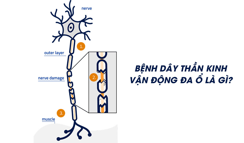 Bệnh dây thần kinh vận động đa ổ là gì?