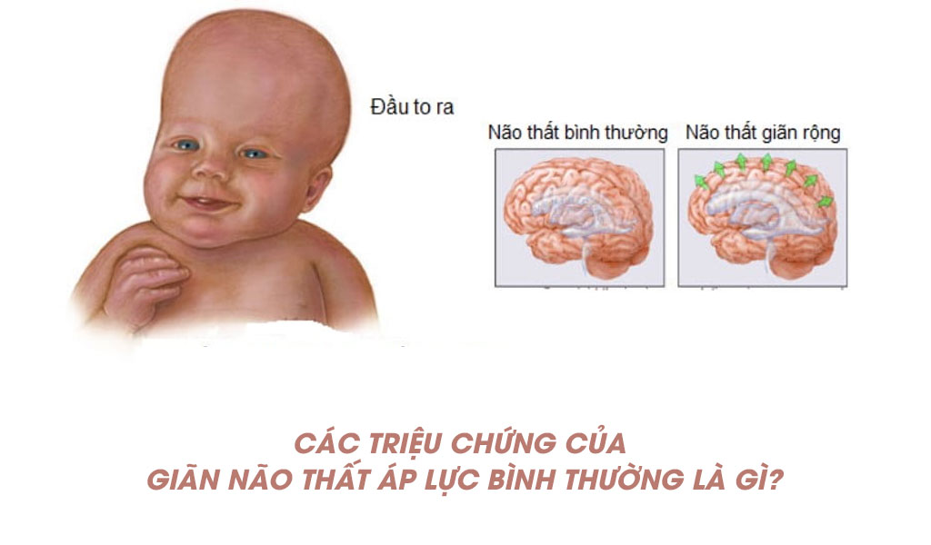 Các triệu chứng của giãn não thất áp lực bình thường là gì?