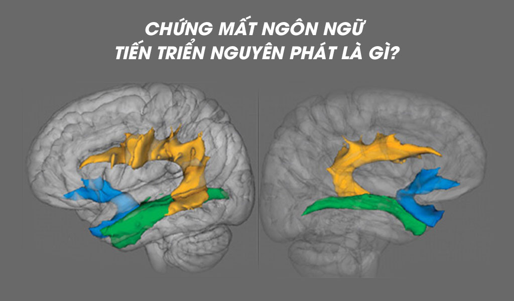 Chứng mất ngôn ngữ tiến triển nguyên phát là gì?