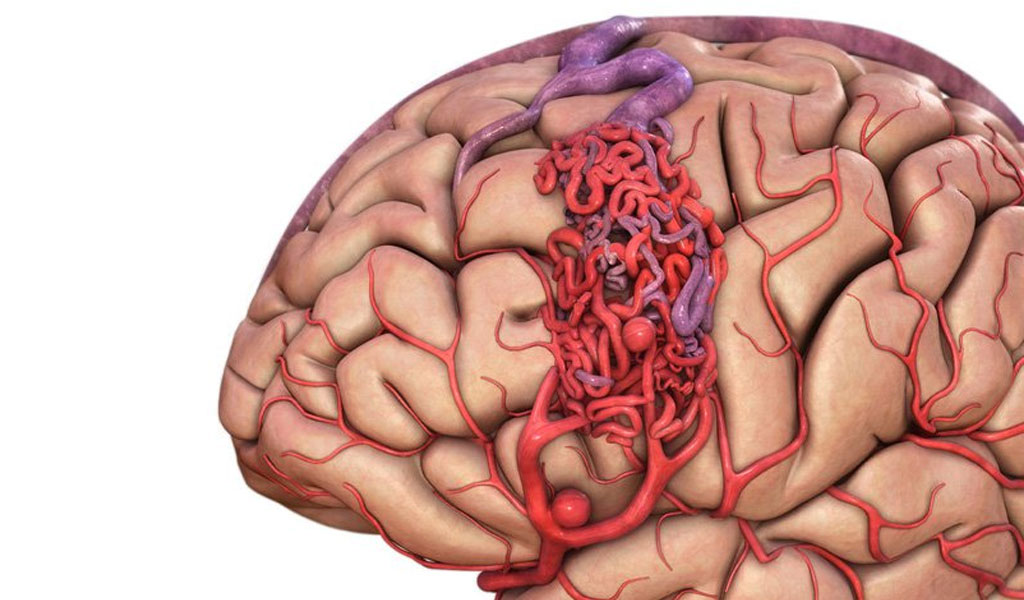 Dị dạng động tĩnh mạch não là gì và chúng ảnh hưởng ra sao?