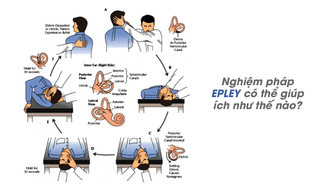 Khi điều trị chứng chóng mặt, nghiệm pháp Epley có thể giúp ích như thế nào?