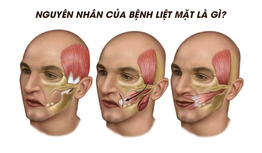 Nguyên nhân của bệnh liệt mặt là gì?