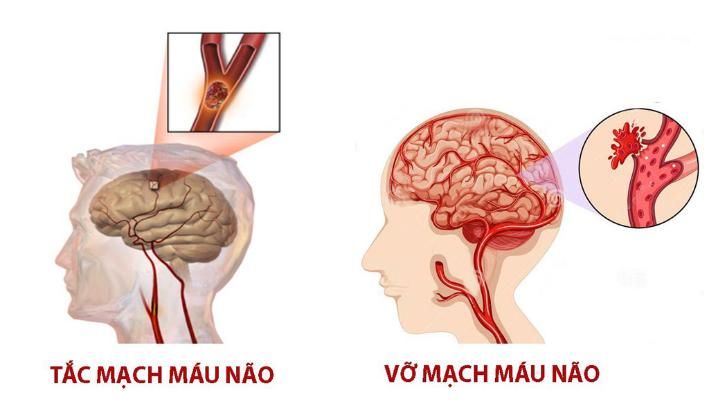 Bệnh não liên quan đến mạch máu là những bệnh gì?