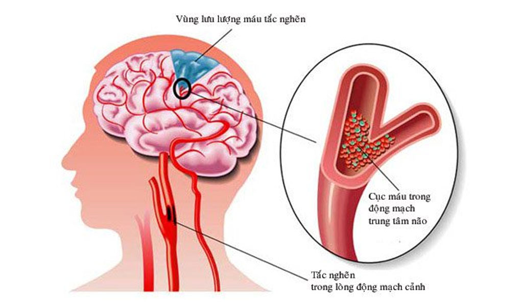 Điều gì gây ra chứng chóng mặt trung ương?