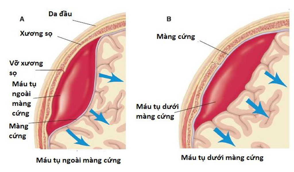 Khối máu tụ dưới màng cứng được chuẩn đoán bằng cách nào? 