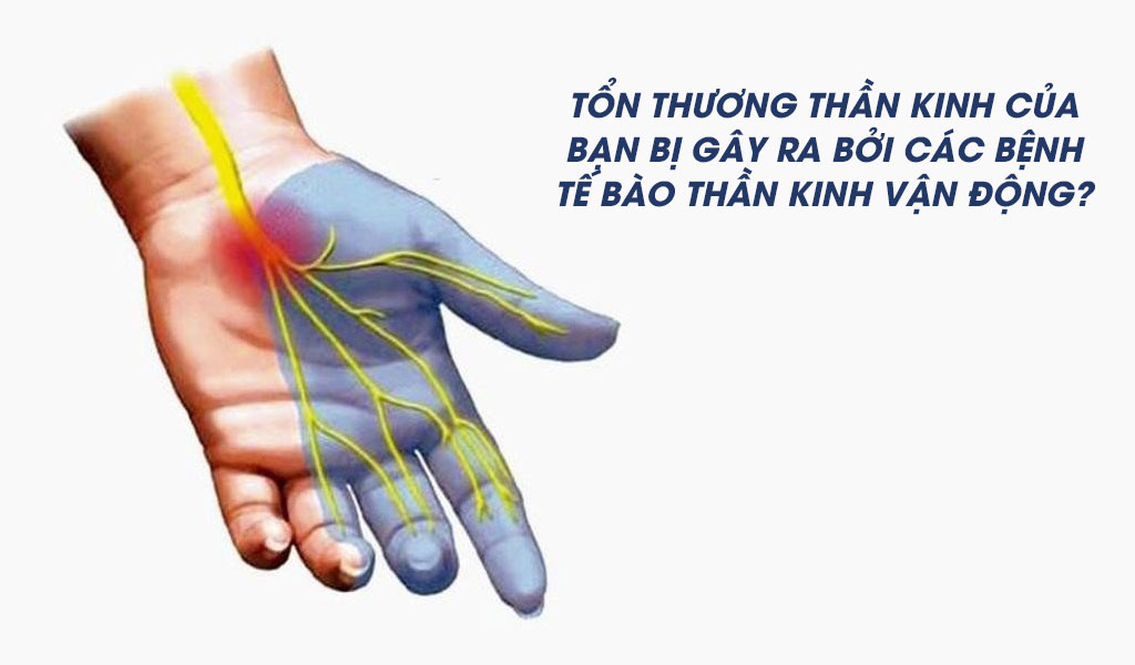 Làm thế nào để bạn có thể biết nếu tổn thương thần kinh của bạn bị gây ra bởi các bệnh tế bào thần kinh vận động?