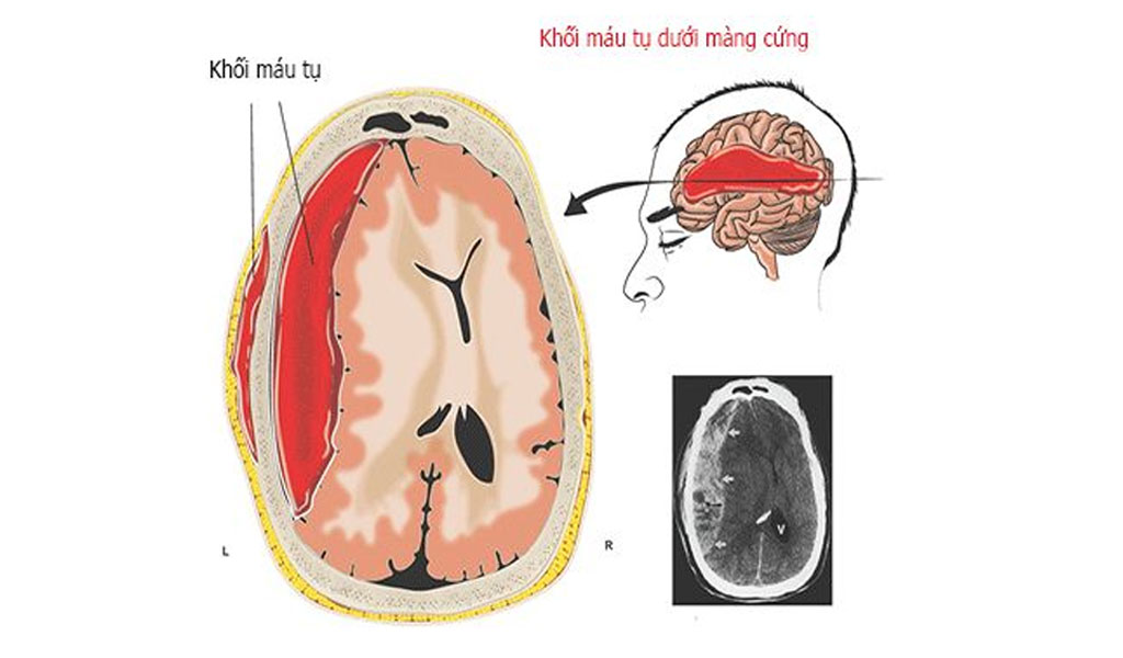  Một số các triệu chứng khác của máu tụ dưới màng cứng là gì?