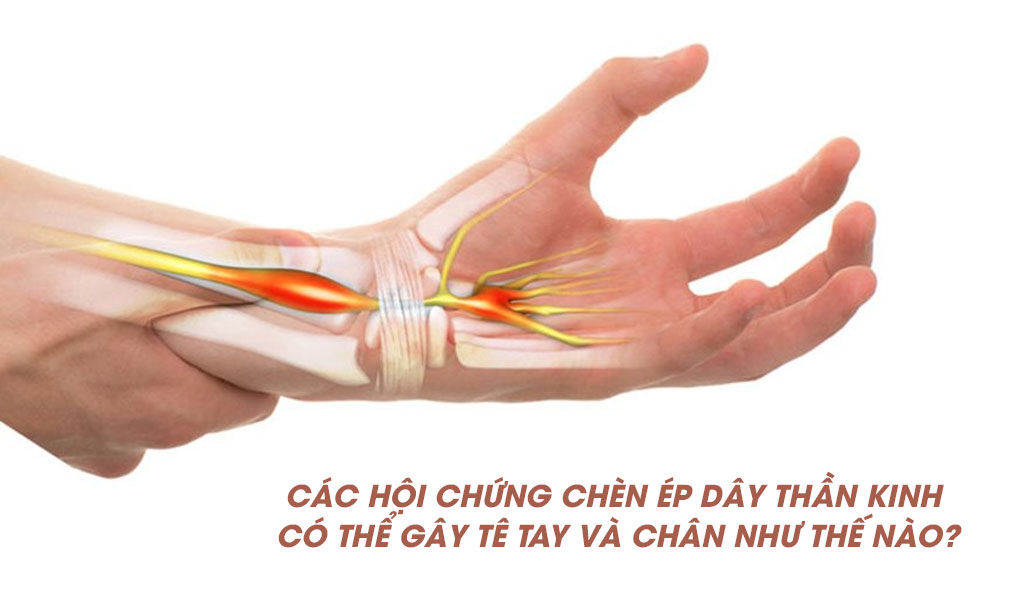 Các hội chứng chèn ép dây thần kinh có thể gây tê tay và chân như thế nào?