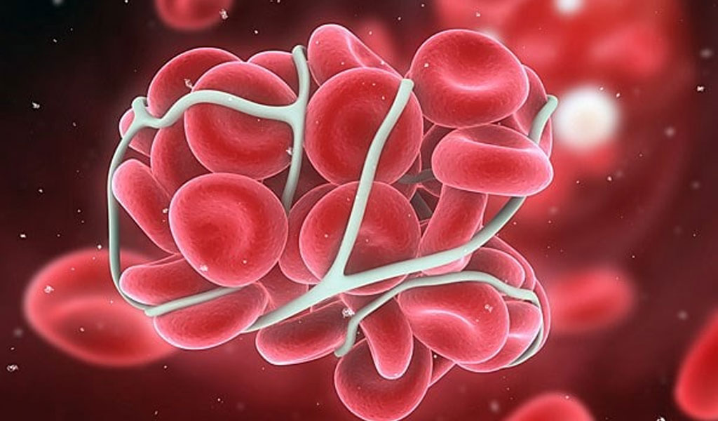 Bệnh đa hồng cầu có gây ra các vấn đề sức khỏe khác không?