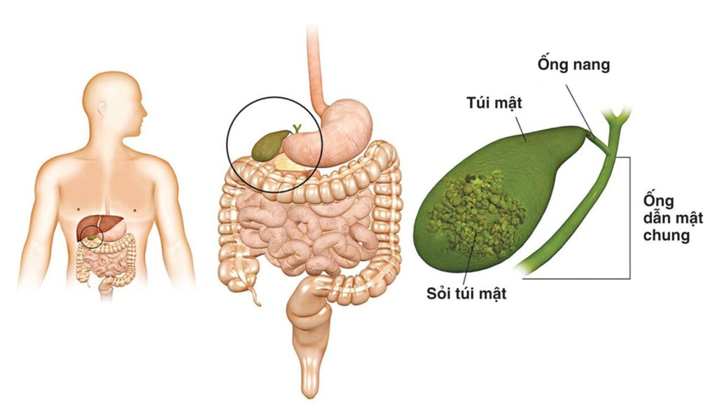 Chữa trị ung thư đường mật bằng phẫu thuật như thế nào?