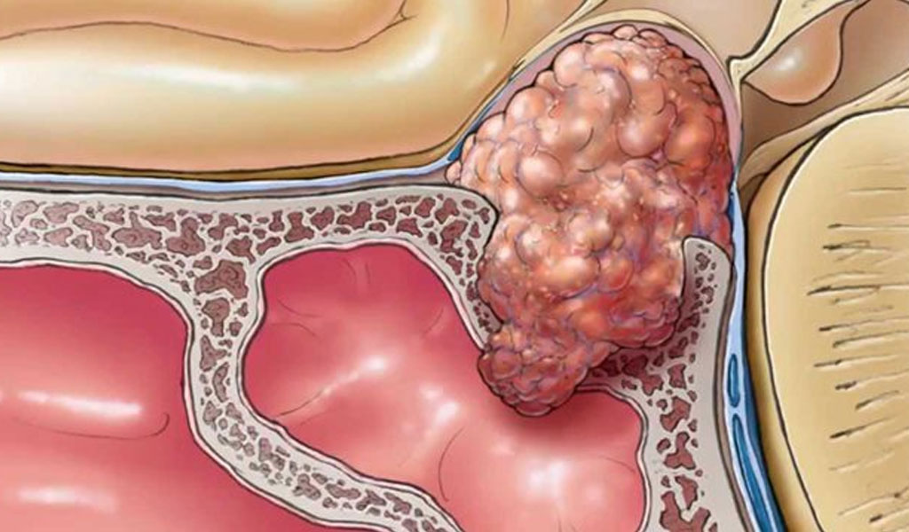 Dấu hiệu của khối u tuyến yên tiết prolactin ở nam giới là gì?