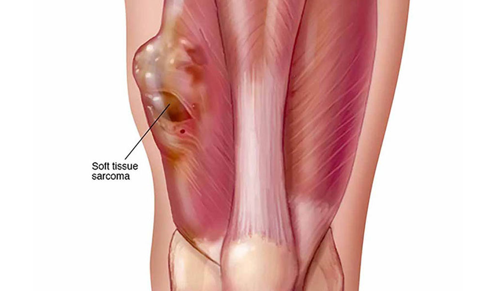 Những ai có nguy cơ mắc Sarcoma?