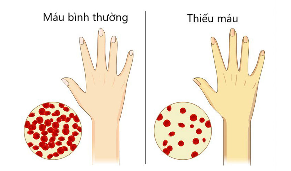 Thiếu máu gây ra mệt mỏi liên quan đến ung thư như thế nào?