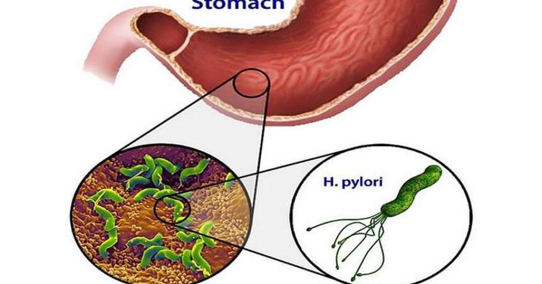 Vi Khuẩn Helicobacter Pylori H Pylori Là Gì 