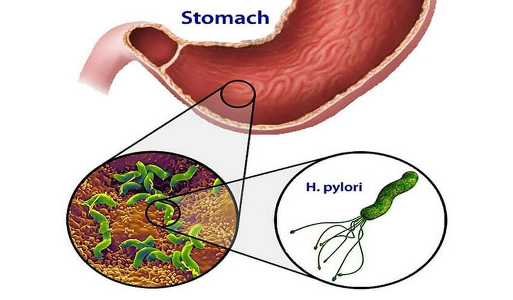 Vi khuẩn helicobacter pylori (H. pylori) là gì?