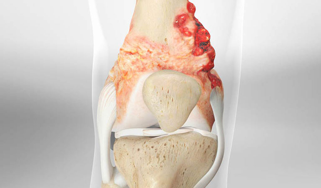 Sarcoma mô mềm có những triệu chứng gì?