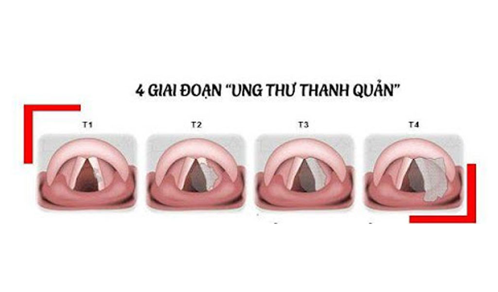 Ung thư thanh quản có những loại nào?