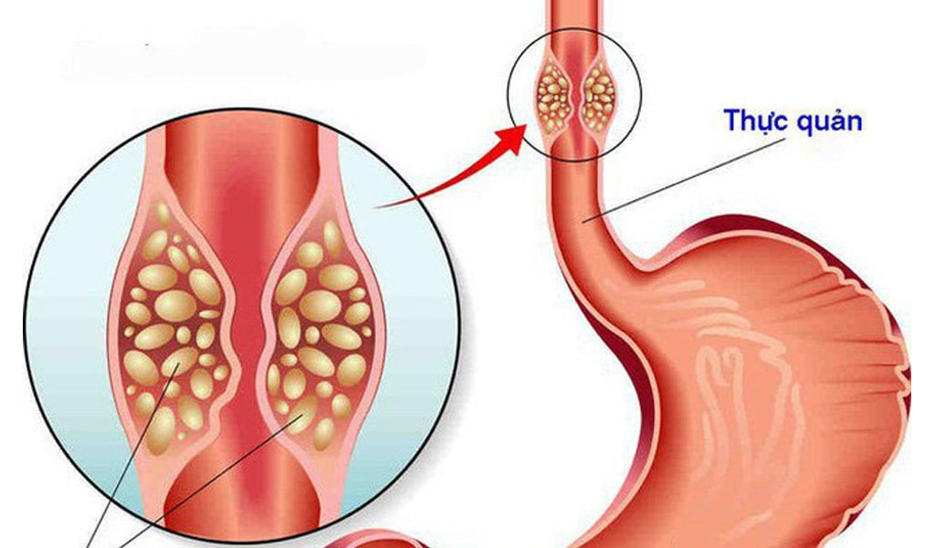 Ung thư thực quản được chẩn đoán như thế nào?