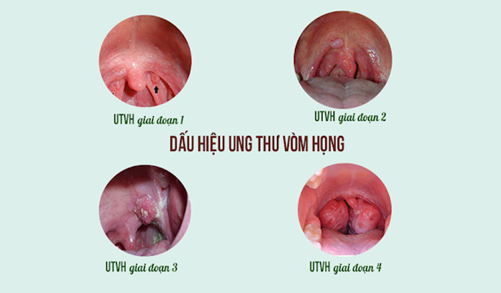 Ung thư vòm họng có những triệu chứng nào?