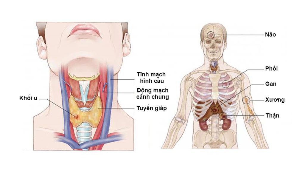 Hệ thống phân loại TNM cho ung thư tuyến giáp là gì?