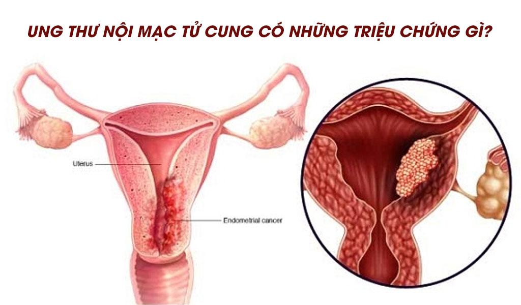 Ung thư nội mạc tử cung có những triệu chứng gì?