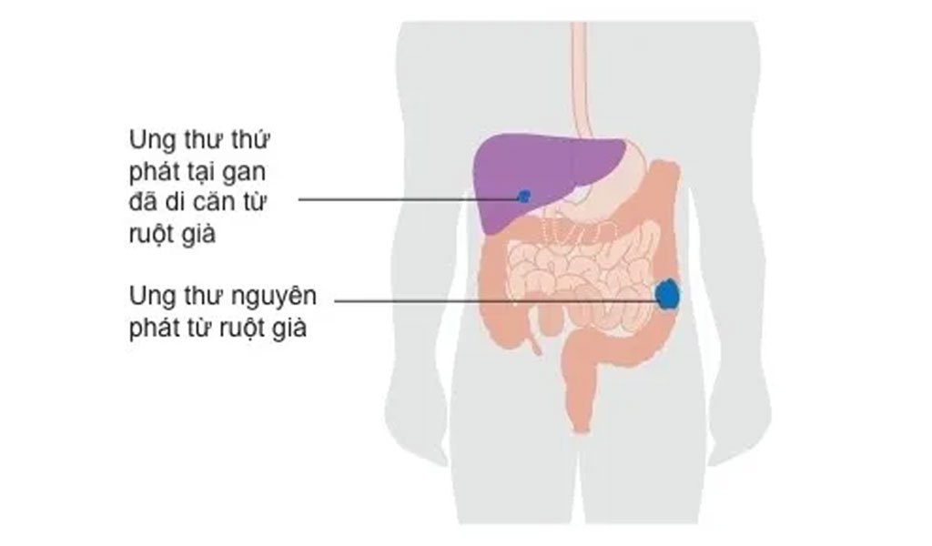 Ung thư thứ phát là gì?