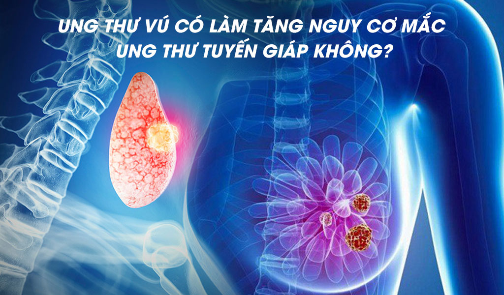 Ung thư vú có làm tăng nguy cơ mắc ung thư tuyến giáp không?