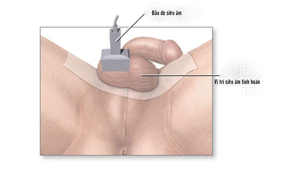 Siêu âm được dùng để chẩn đoán ung thư tinh hoàn như thế nào?