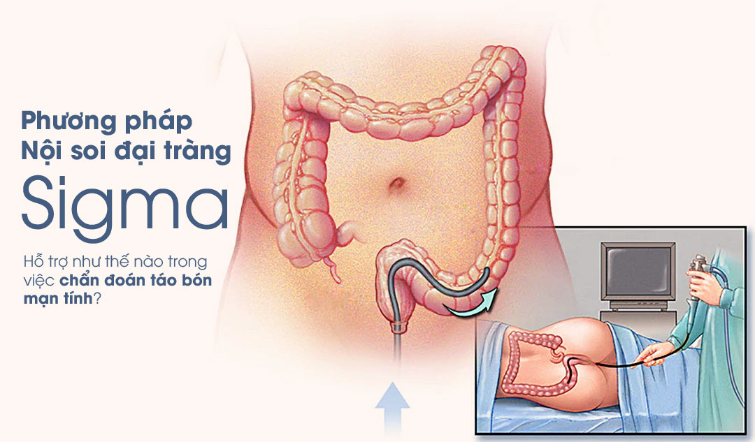 Phương pháp Nội soi đại tràng sigma hỗ trợ như thế nào trong việc chẩn đoán táo bón mạn tính?