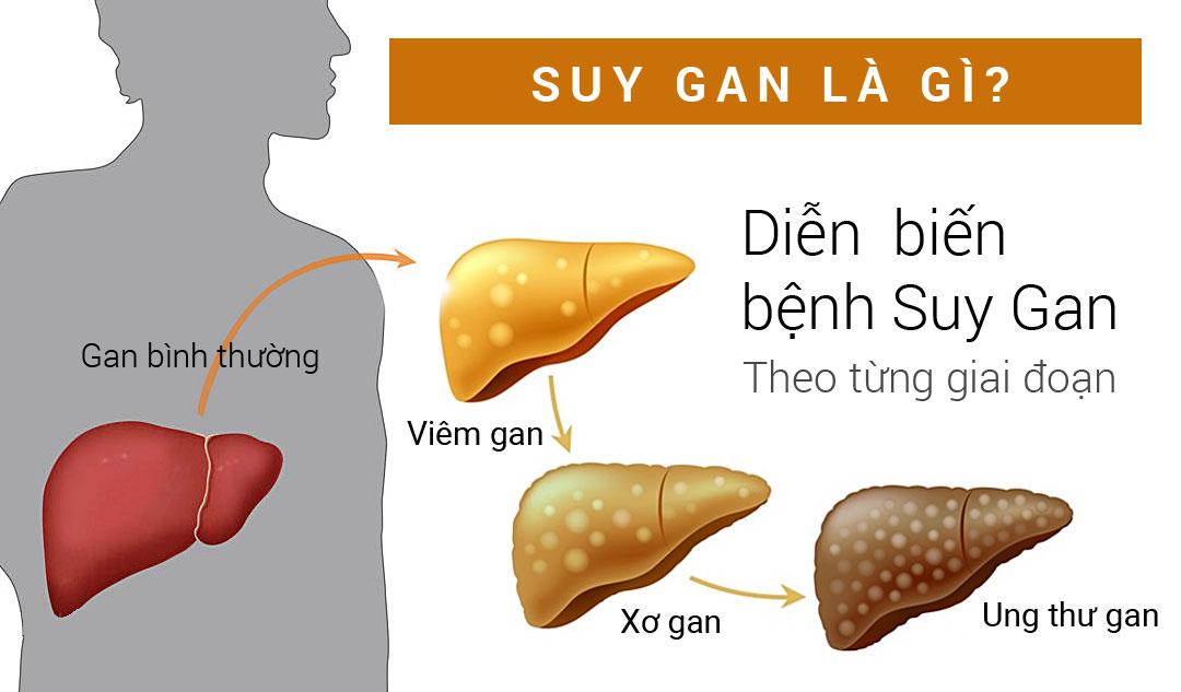 Suy gan là gì?