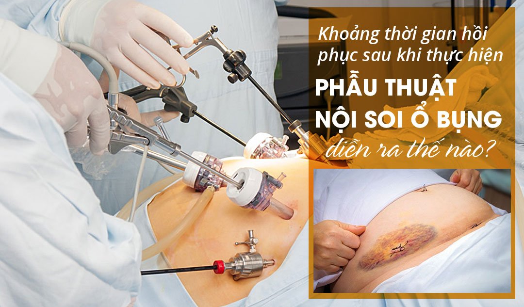 Khoảng thời gian hồi phục sau khi thực hiện phẫu thuật nội soi ổ bụng diễn ra thế nào?