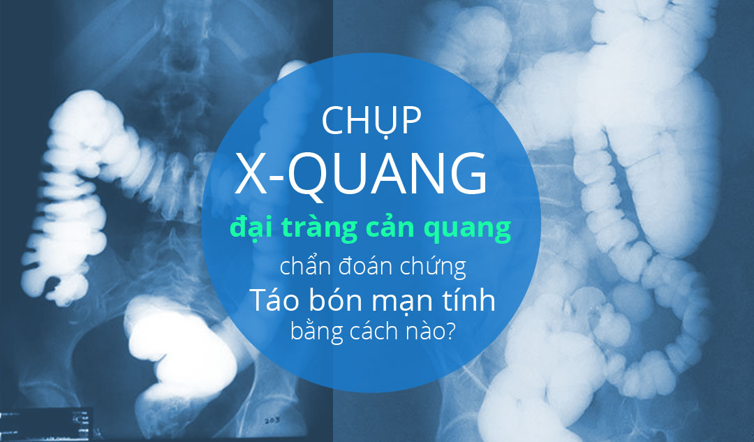 Chụp X-quang đại tràng cản quang có thể giúp chẩn đoán chứng táo bón mạn tính bằng cách nào?