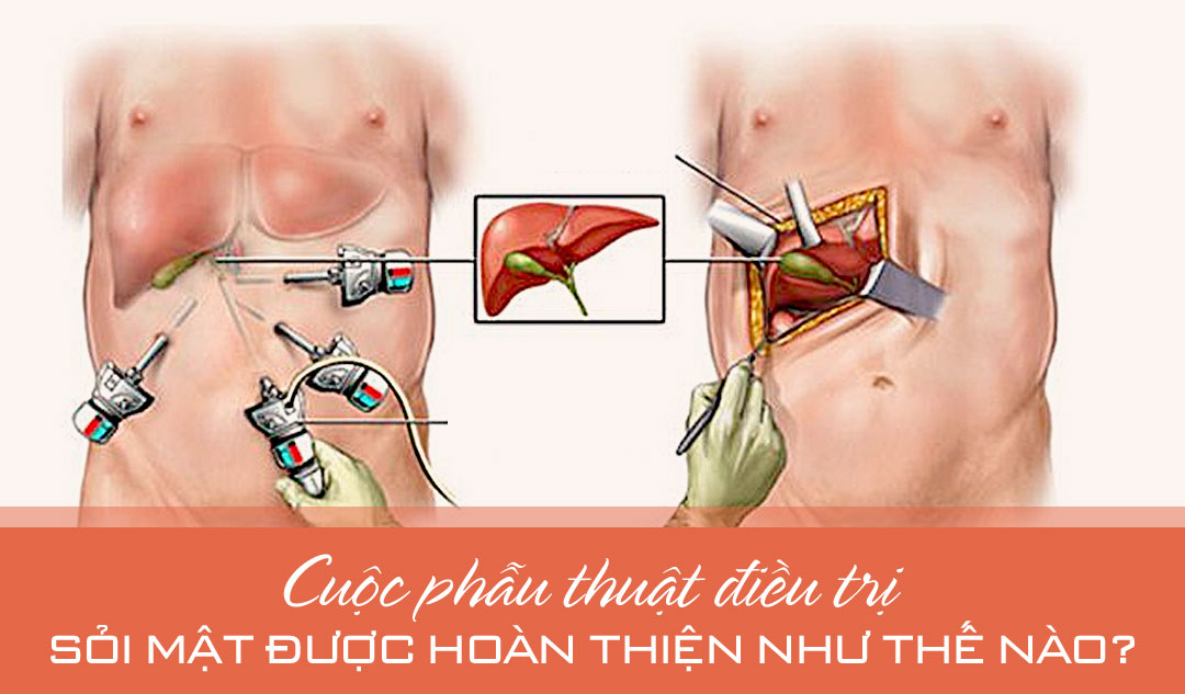 Cuộc phẫu thuật điều trị sỏi mật được hoàn thiện như thế nào?